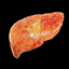 Avatar of Hepatic Steatosis